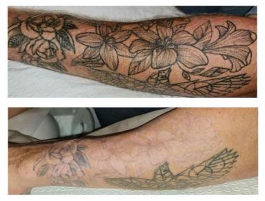 Business For Sale - NSW - Lane Cove - 2066 - Premium Tattoo Removal & Skin Rejuvenation Clinic in Lane Cove, NSW (Image 2)