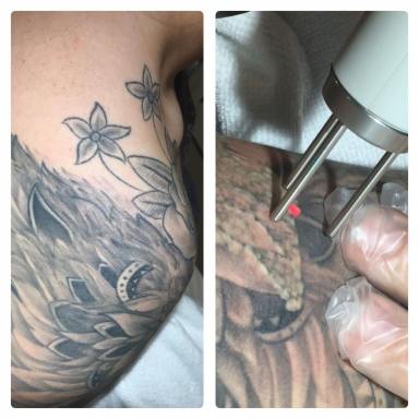Business For Sale - NSW - Lane Cove - 2066 - Premium Tattoo Removal & Skin Rejuvenation Clinic in Lane Cove, NSW  (Image 2)